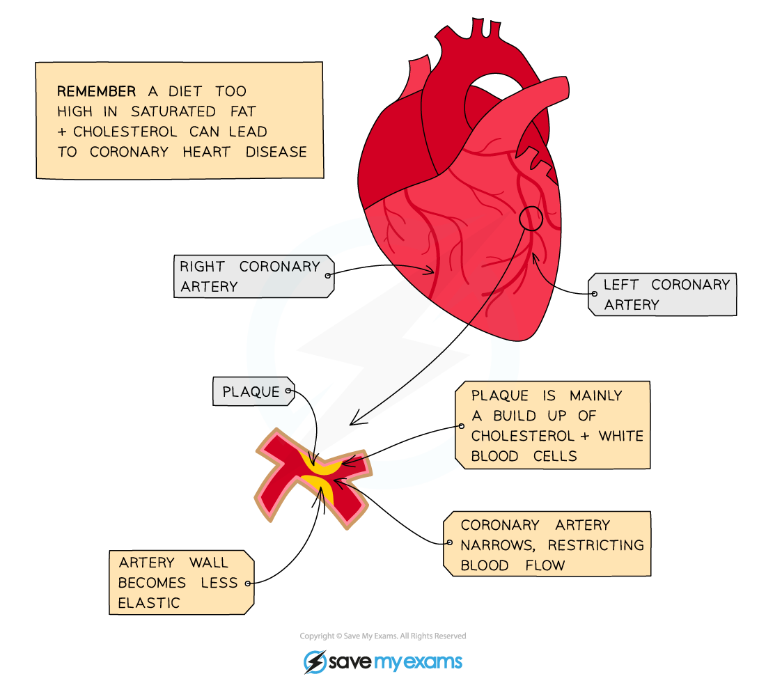 Buildup of plaque in the coronary arteries, IGCSE & GCSE Biology revision notes