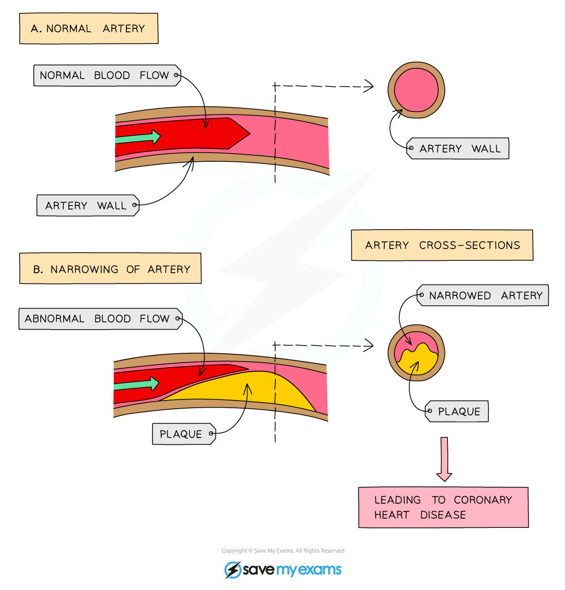 Effect of narrowing of arteries, IGCSE & GCSE Biology revision notes