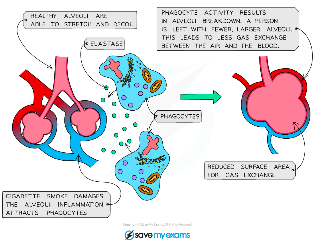 Emphysema in the lungs, IGCSE & GCSE Biology revision notes