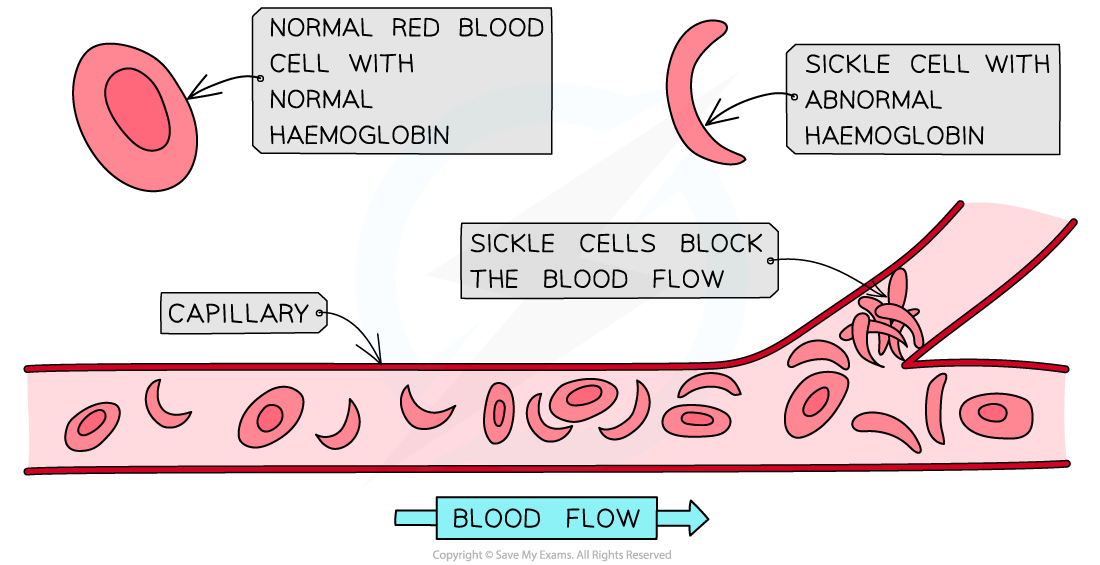 Sickle and Normal red blood cells, downloadable AS & A Level Biology revision notes