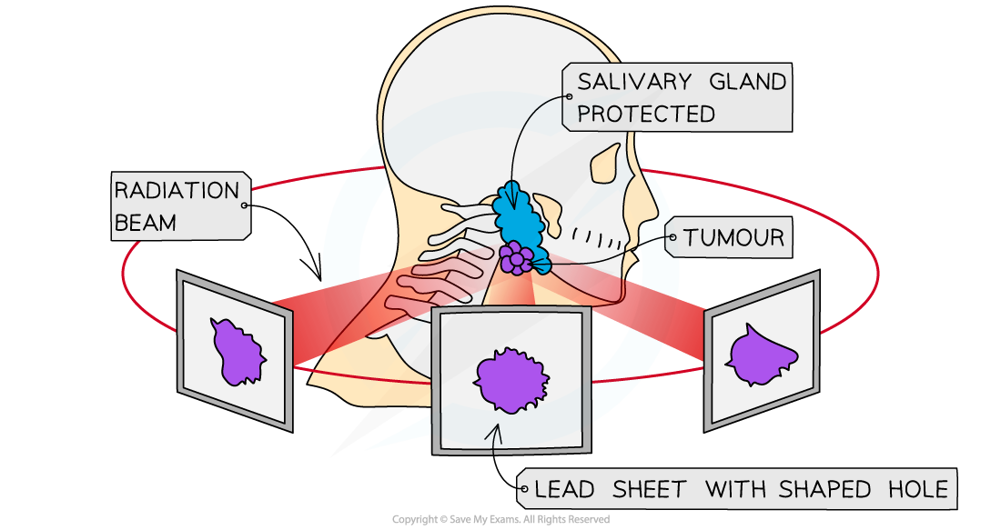 Radiation Therapy 2, downloadable AS & A Level Physics revision notes