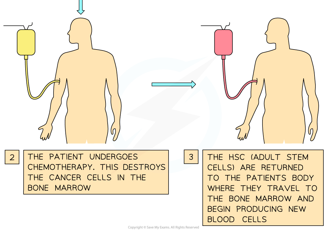 Therapeutic uses of embryonic and adult stem cells 3, downloadable IB Biology revision notes