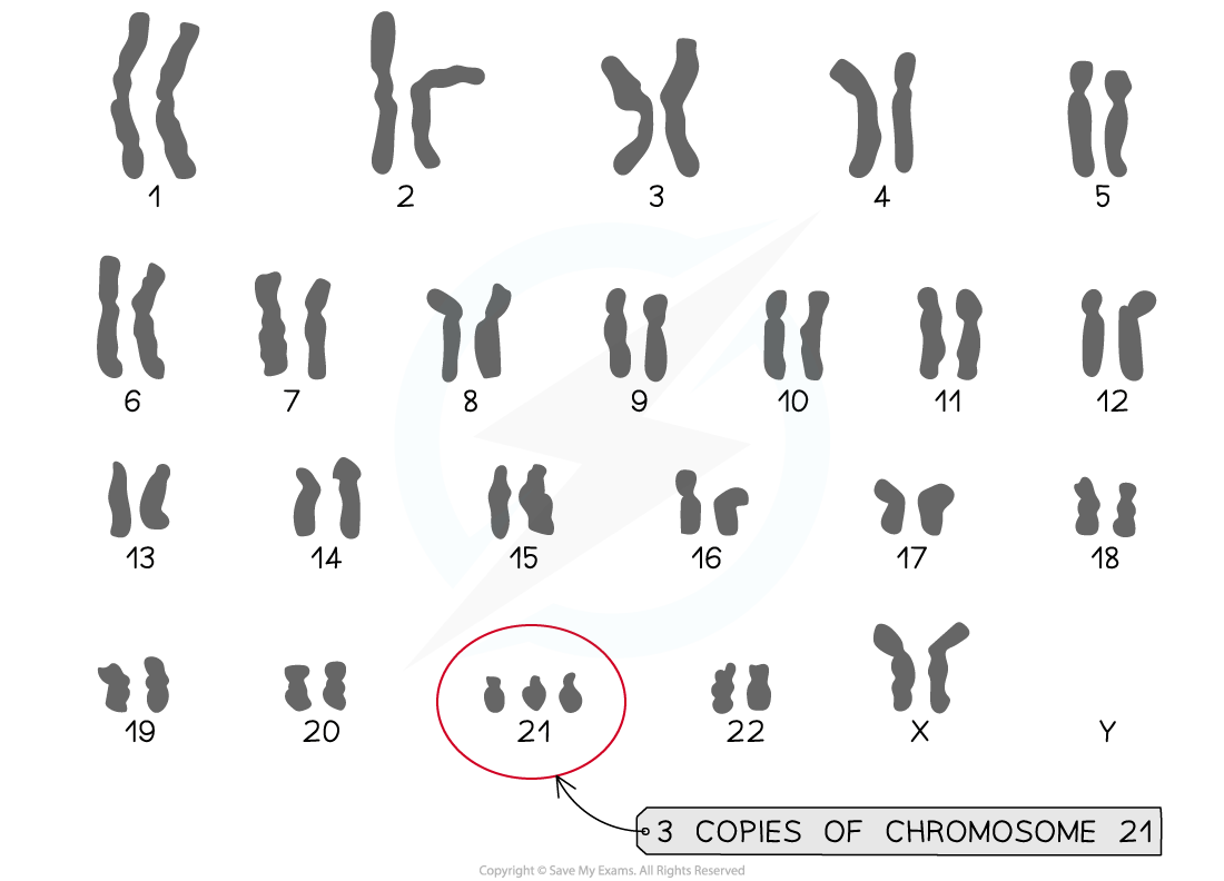 Karyogram showing Downs Syndrome Karyotype, downloadable IB Biology revision notes